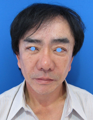 目の下のたるみ、目のくまでお悩みの方、切らずに完璧に解決します。TCB-R法　手術直後　症例写真